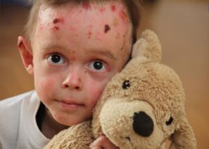 حمایت گروه مالی شهر از بیماران پروانه‌ای